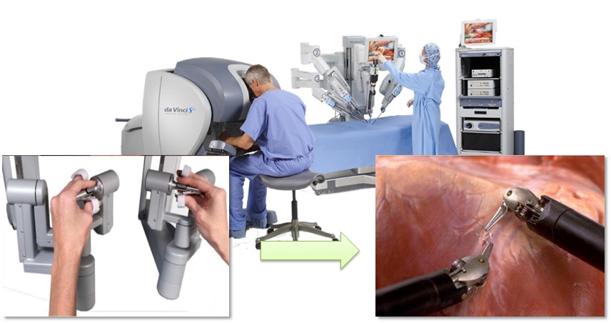 腹腔鏡・手術支援ロボットを用いた胃がん手術