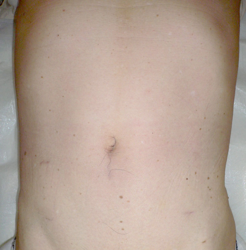 腹腔鏡下大腸切除の写真（S状結腸切除）