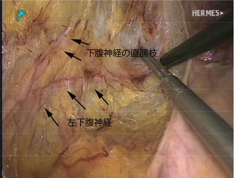 図2：直腸がん手術の手術画像