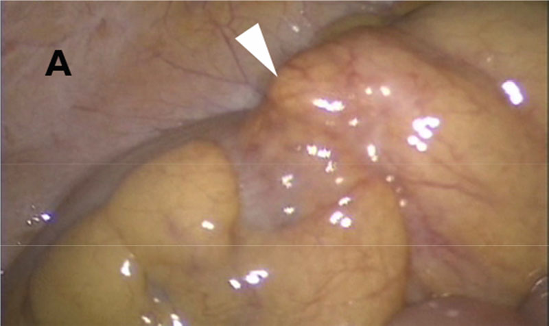 進行Ｓ状結腸がんの手術画像
