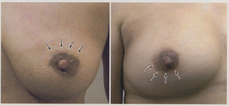 乳房温存手術