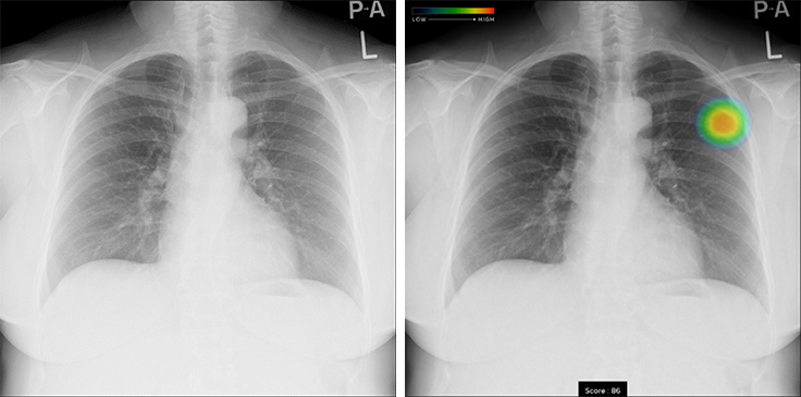 胸部X線画像病変検出ソフトウェアCXR-AID