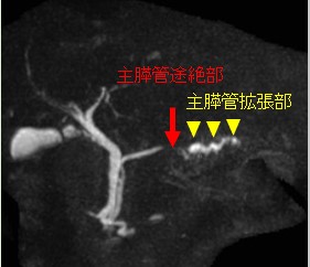 消化器内科 主な疾患（膵がん）画像02