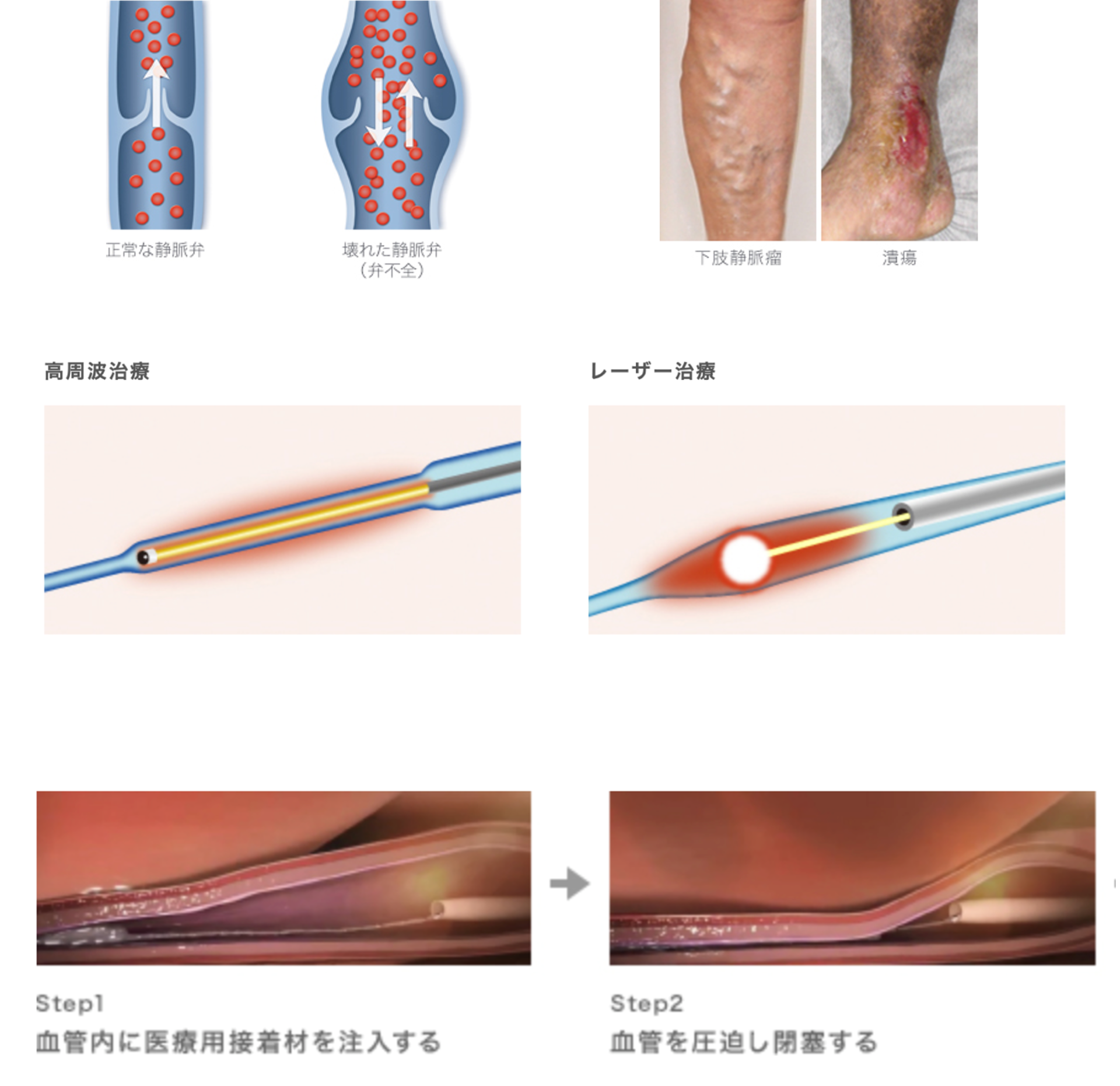 下肢静脈瘤の画像