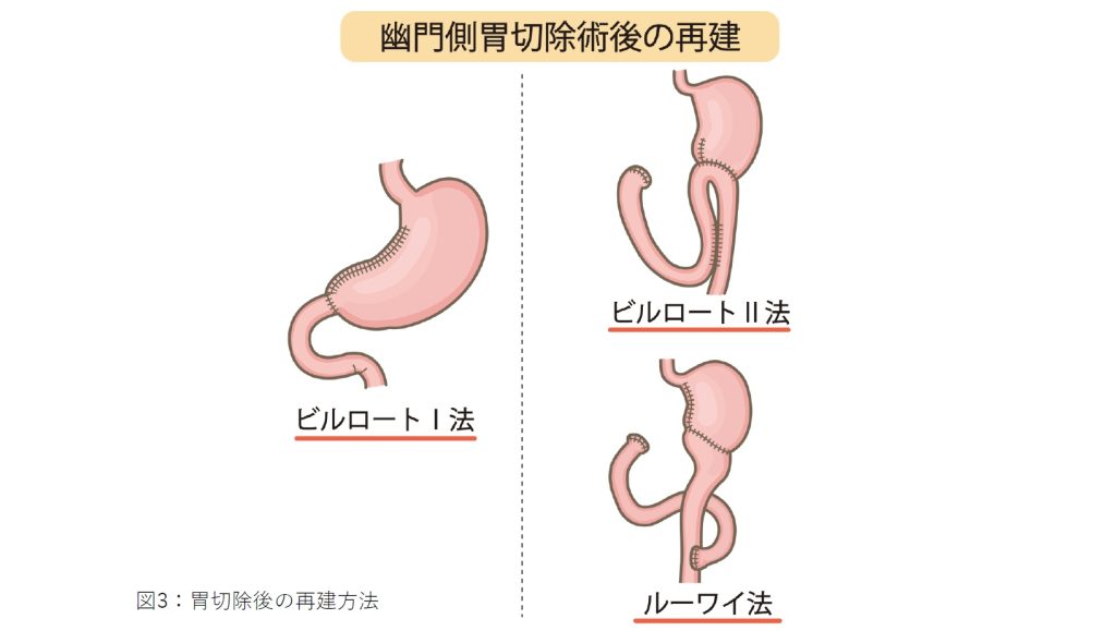 消化器外科の主な疾患画像３